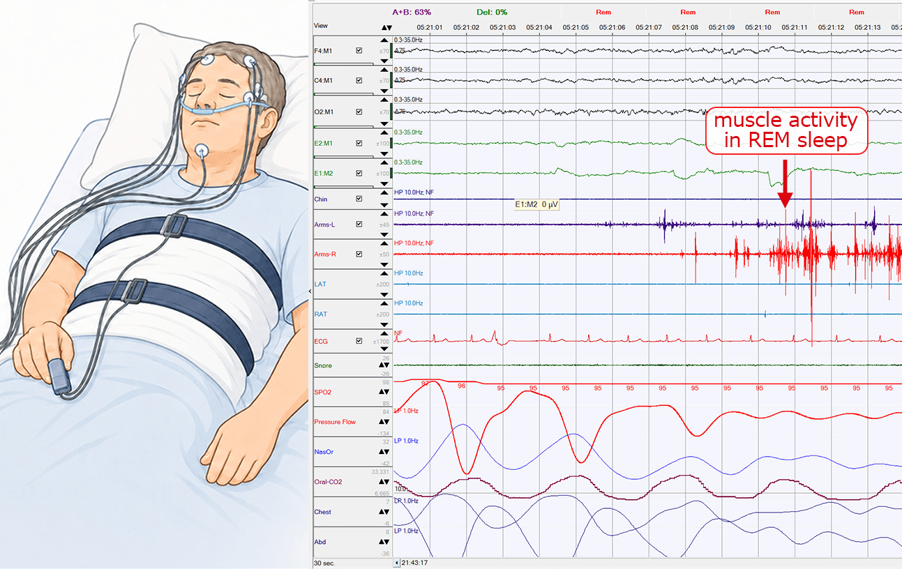 Illustration of an overnight polysomnography recording in a sleep laboratory.