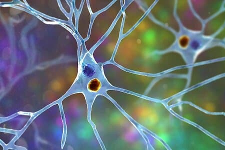Illustration of misfolded alpha-synuclein protein accumulating in the brainstem circuits that control REM atonia.